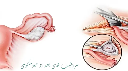نکات مراقبتی بعد از میومکتومی